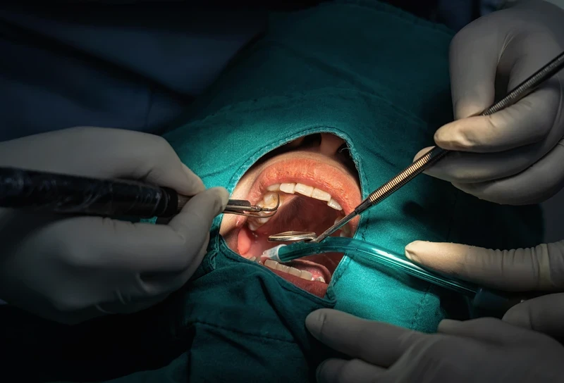 Chirurgie parodontale : Technique enseignée durant les études dentaires en Espagne